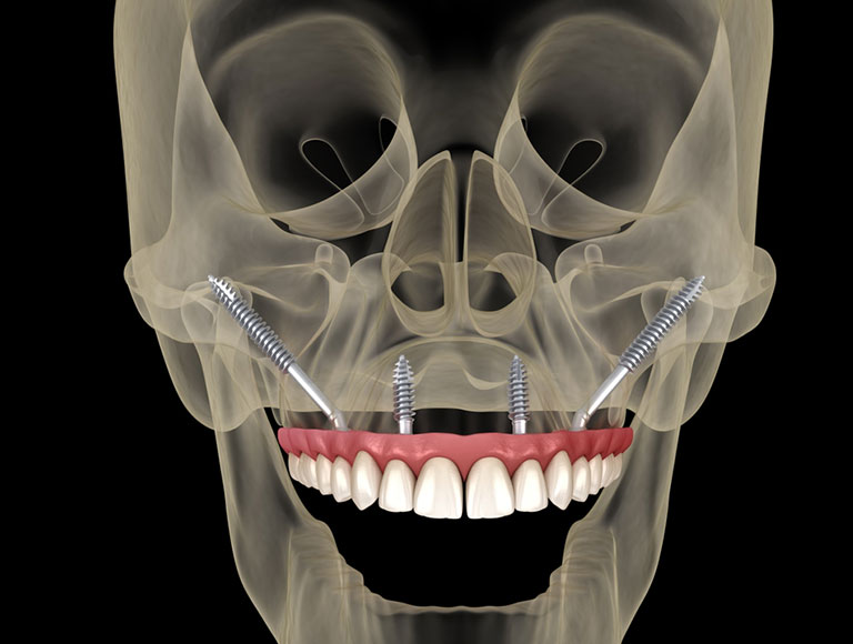 Zygomatic Implants