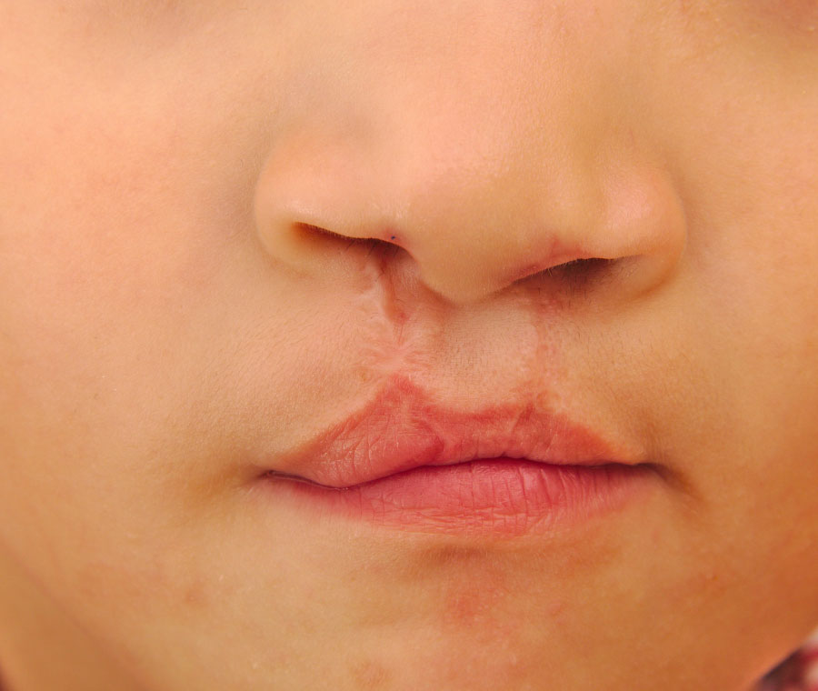 Typically Needs Cleft Lip
