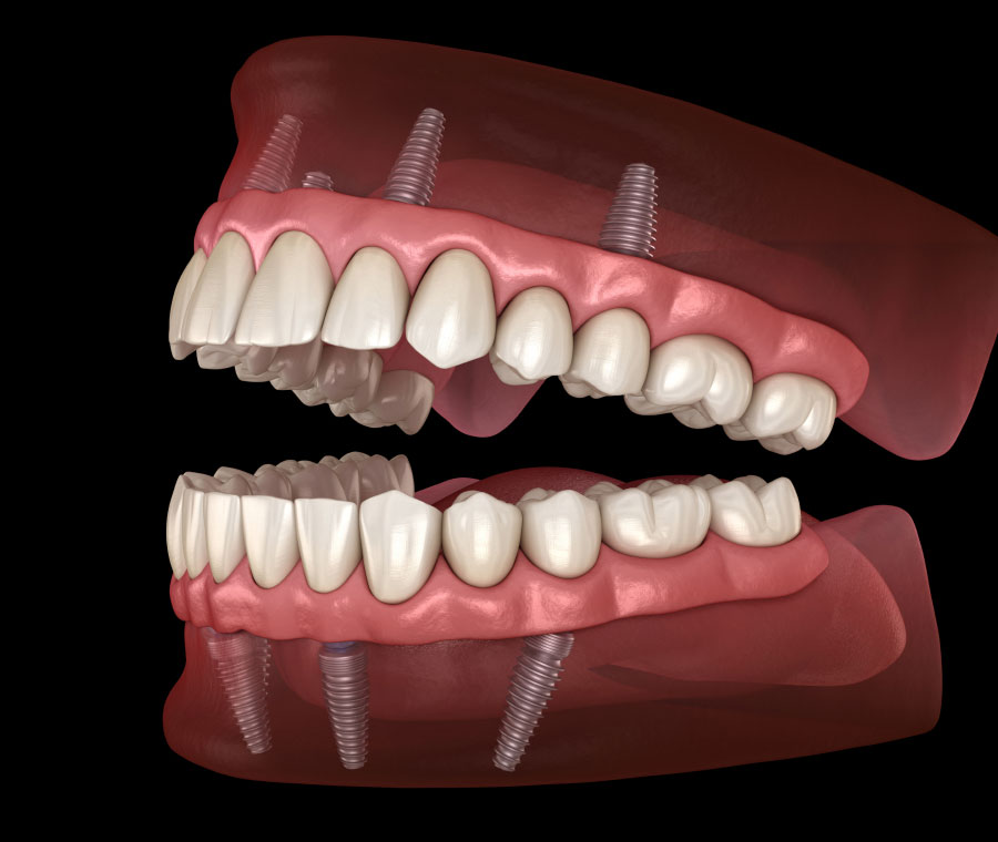 Teeth-In-A-Day Solutions