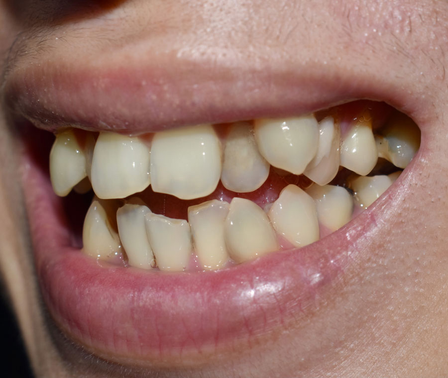 Needs Impacted Canine Treatment