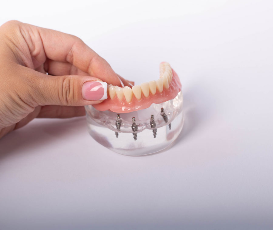 Dental Implant Process